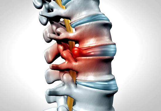 Bel Fıtığı Nasıl Geçer? Pilates İyi Gelir Mi?